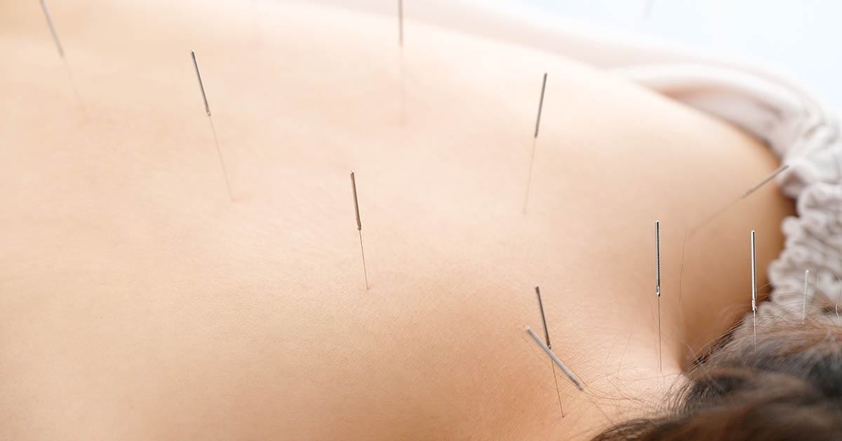 Acupuntura